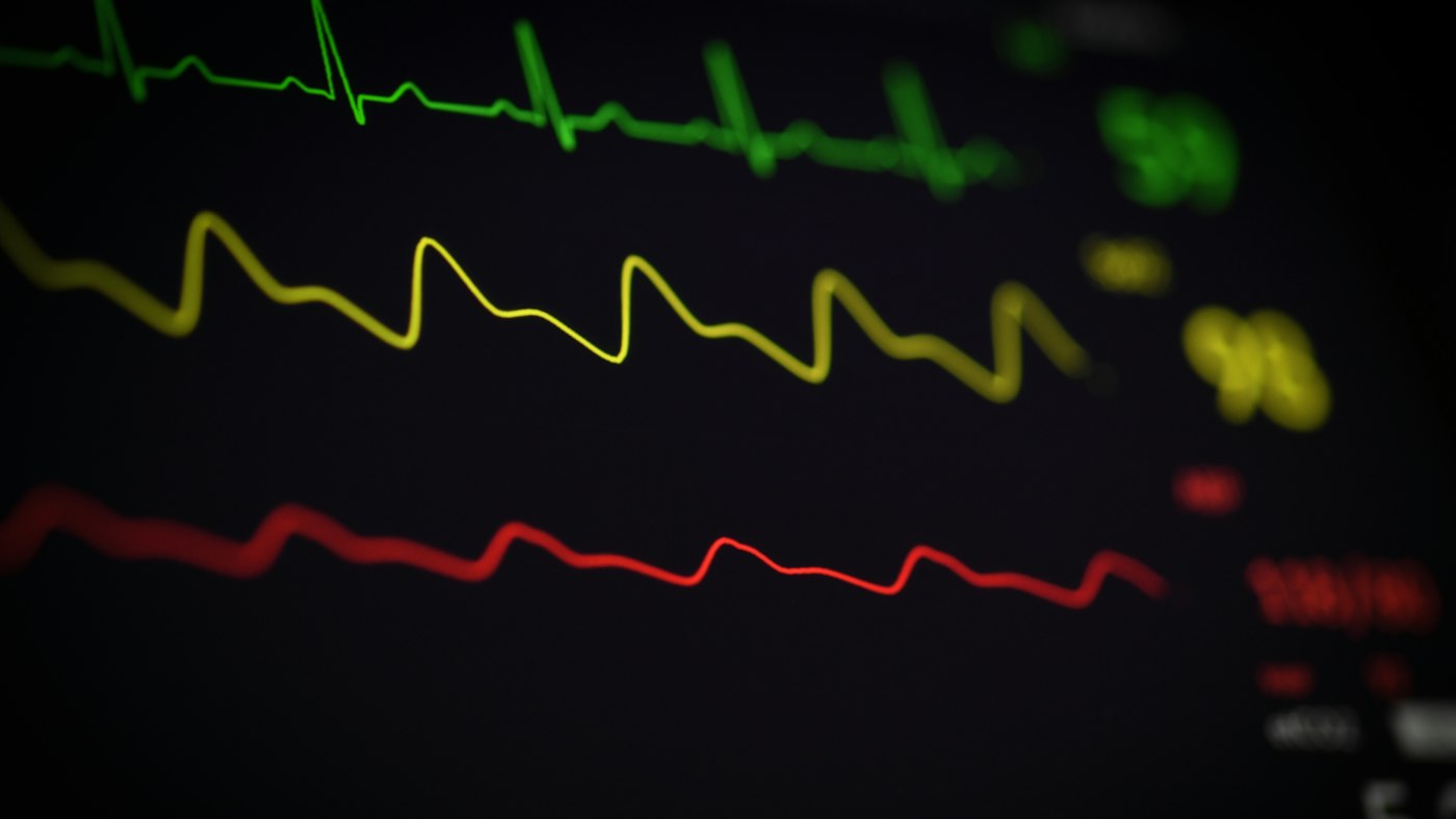 Heart rhythm lines on a patient monitor